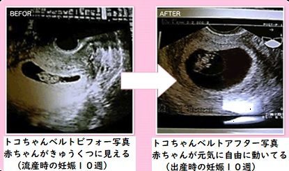 妊娠初期:胎のうが左図の方、トコちゃんベルトⅡして下さい